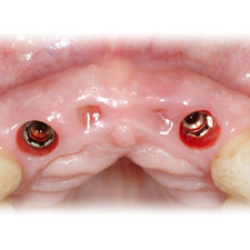 mancanza di denti singola o multipla