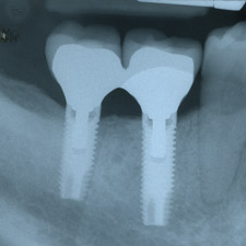 Ricostruzione della masticazione mediante impianti