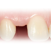 sostituzione di dente singolo