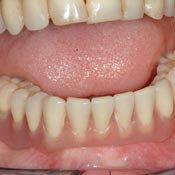 sostituzione di più denti