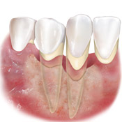 infiammazione gengivale denti mobili