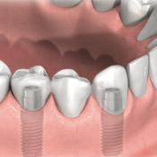 mancanza di denti singola o multipla