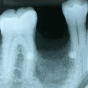 mancanza di osso per implantologia